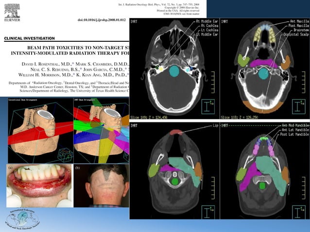 Neck Fix Radiotherapy Radiation therapy for head and neck cancer by Brian O'Sullivan | PDF