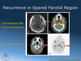 Recurrence in Spared Parotid Region


Pre-treatment MRI
& Dose distribution




Recurrence PET/CT



 2012




                      Cannon & N Lee, IJROBP 2008
 