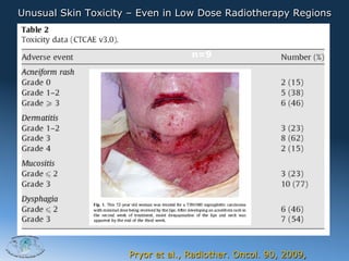Unusual Skin Toxicity – Even in Low Dose Radiotherapy Regions

                                   n=13
                                   Cetux abgebrochen bei
                                   n=9




2012




                     Pryor et al., Radiother. Oncol. 90, 2009,
 