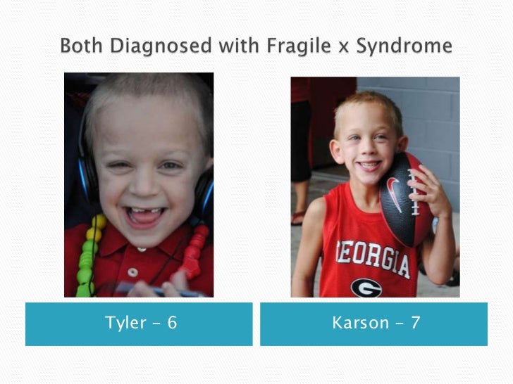 Fragile x syndrome
