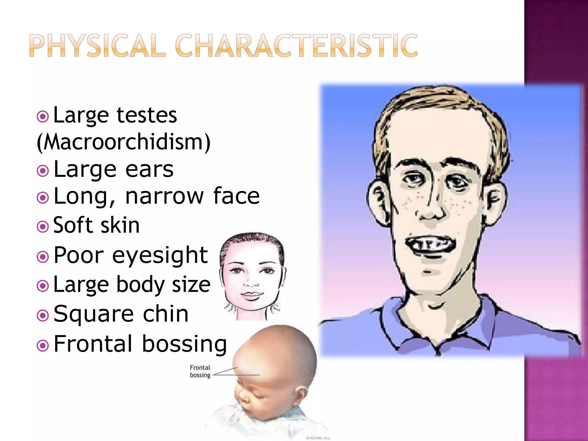  Large testes
(Macroorchidism)
 Large ears
 Long, narrow face
 Soft skin
 Poor eyesight
 Large body size
 Square chin
 Frontal bossing
 