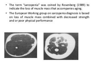 • The term “sarcopenia” was coined by Rosenberg (1989) to
indicate the loss of muscle mass that accompanies aging.
• The European Working group on sarcopenia diagnosis is based
on loss of muscle mass combined with decreased strength
and or poor physical performance
 