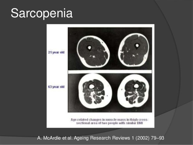 Sarcopenia
A. McArdle et al. Ageing Research Reviews 1 (2002) 79–93
 