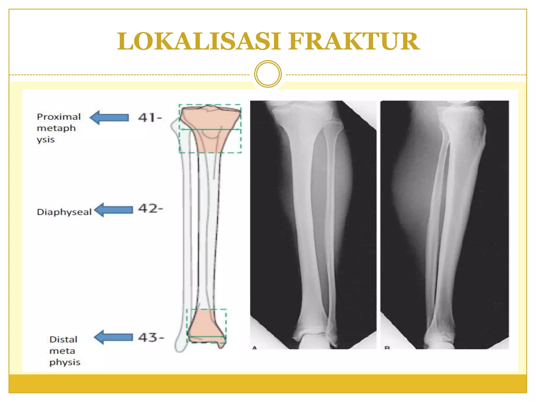 Fraktur tibia | PPTX
