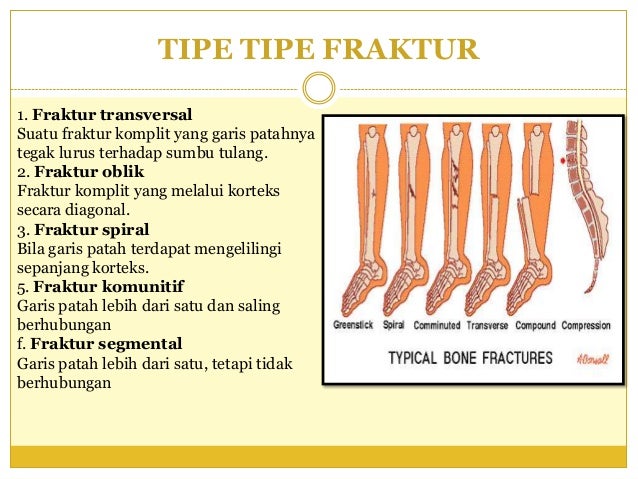 Fraktur Terbuka Pada Tulang Tibia Eva