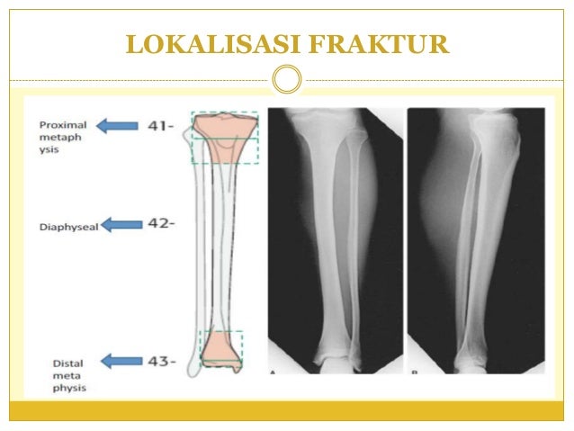Fraktur Terbuka Pada Tulang Tibia – Eva