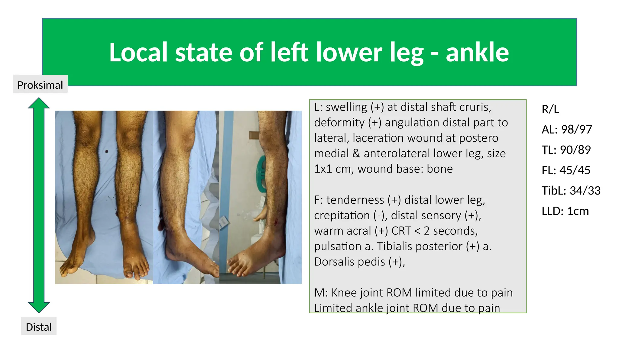 fraktur tibia fibula 2.pptx fraktur tibia fibula 2.pptx