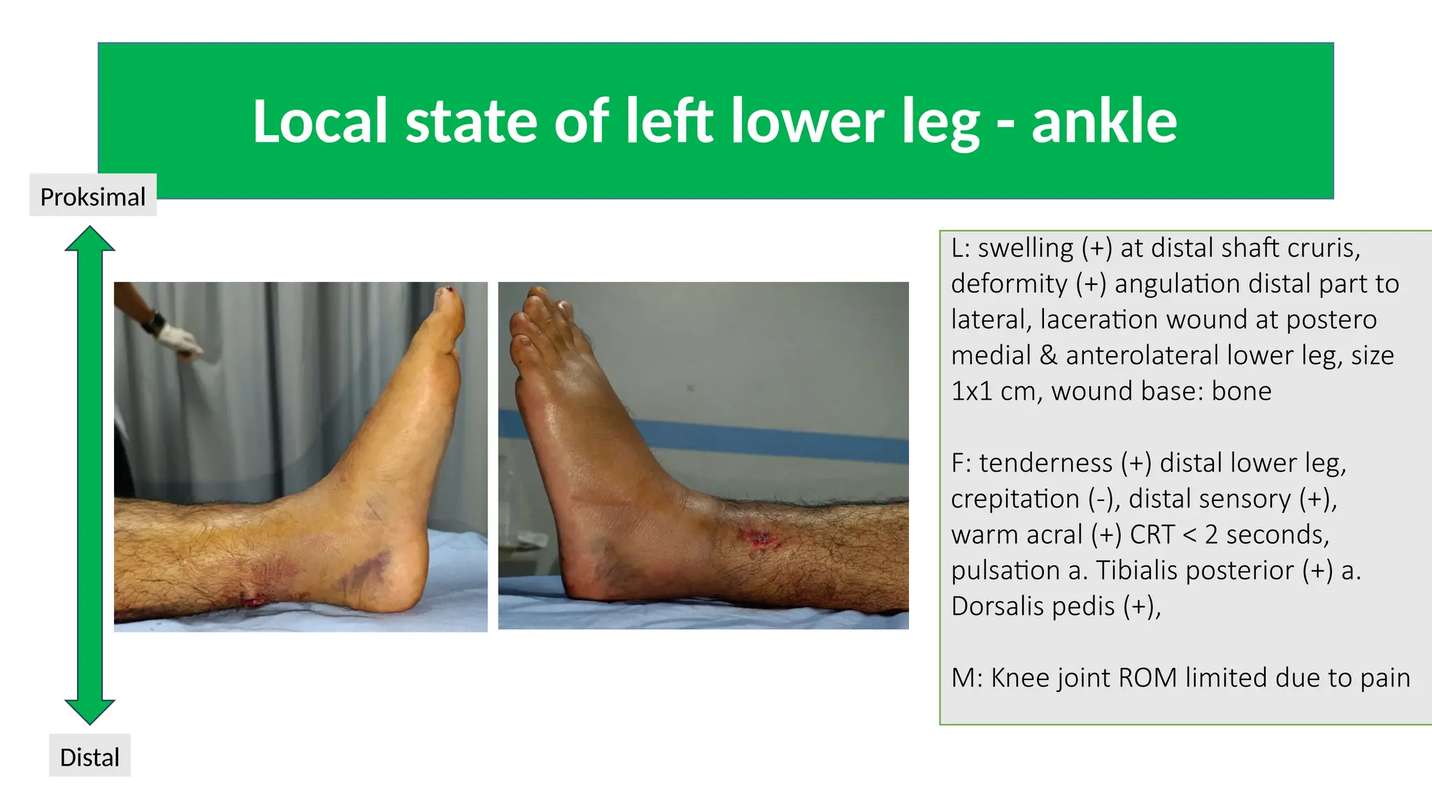 fraktur tibia fibula 2.pptx fraktur tibia fibula 2.pptx