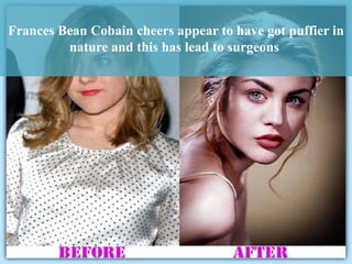 Frances Bean Cobain Plastic Surger PPTX frances-bean-cobain-plastic-surger-pptx