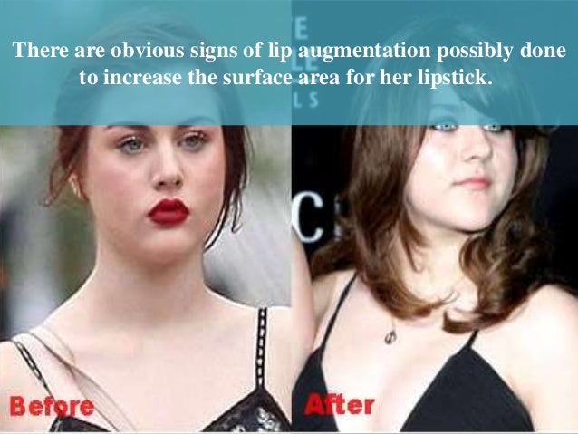 frances bean cobain plastic surgery