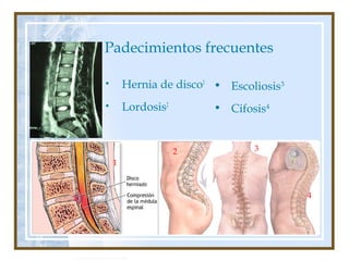 Autor: Rafael Pineda
Padecimientos frecuentes
• Hernia de disco1
• Lordosis2
• Escoliosis3
• Cifosis4
1
2 3
4
 