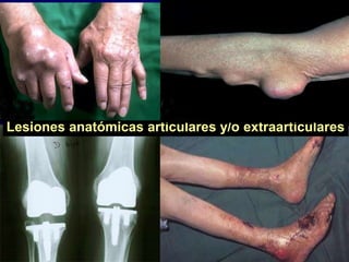 Lesiones anatómicas articulares y/o extraarticulares
 