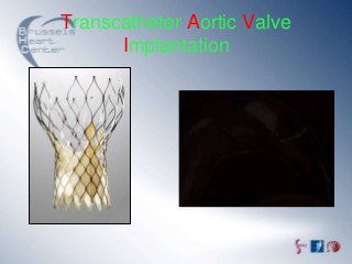 Transcatheter Aortic Valve
      Implantation
 