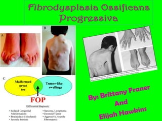 Fibrodysplasia Ossificans Progressiva By: Brittany Franer  And Elijah Hawkins 