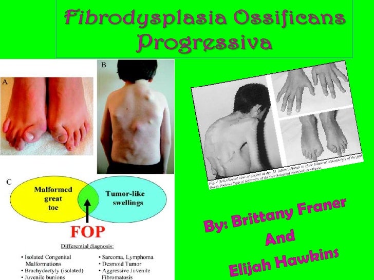 Fibrodysplasia Ossifican Progressiva