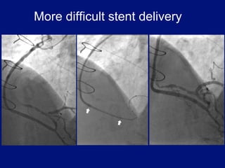 More difficult stent delivery
 