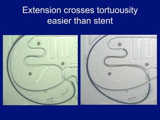 Extension crosses tortuousity
     easier than stent
 
