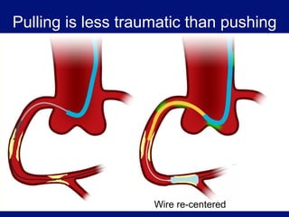 Pulling is less traumatic than pushing




                    Wire re-centered
 