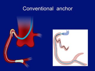 Conventional anchor
 
