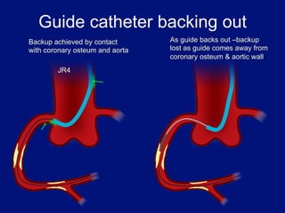 Guide catheter backing out
Backup achieved by contact       As guide backs out –backup
with coronary osteum and aorta   lost as guide comes away from
                                 coronary osteum & aortic wall
        JR4
 