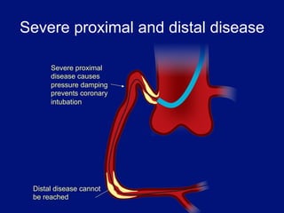 Severe proximal and distal disease

      Severe proximal
      disease causes
      pressure damping
      prevents coronary
      intubation




 Distal disease cannot
 be reached
 