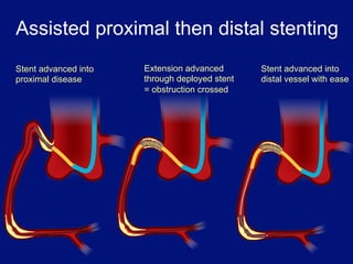 Assisted proximal then distal stenting
Stent advanced into   Extension advanced       Stent advanced into
proximal disease      through deployed stent   distal vessel with ease
                      = obstruction crossed
 