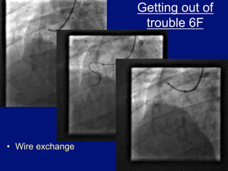 Getting out of
                    trouble 6F




•  Wire exchange
 