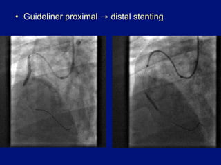 •  Guideliner proximal → distal stenting
 