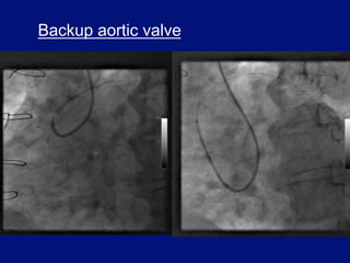 Backup aortic valve
 