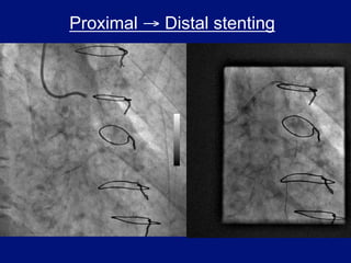 Proximal → Distal stenting
 