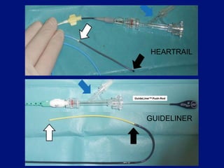 HEARTRAIL




GUIDELINER
 