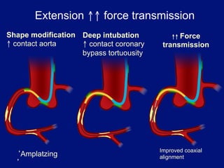 Extension ↑↑ force transmission
Shape modification Deep intubation          ↑↑ Force
↑ contact aorta    ↑ contact coronary    transmission
                   bypass tortuousity




                                        Improved coaxial
   Amplatzing                           alignment
 