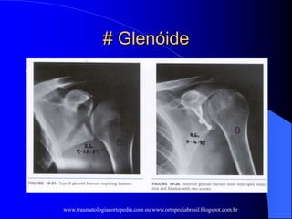 # Glenóide
  Tipo I  avulsão anterior (+ comum após
luxações ou subluxações)
desvio  predispõem instabilidade
fragmento > 10mm ou > 1/3 ou ¼ 
fixação c/ parafuso
 Tipo II  fratura transversa c/ fragmento
triangular inferior desviado
subluxação inferior: redução aberta +
capsuloplastia
www.traumatologiaeortopedia.com ou www.ortopediabrasil.blogspot.com.br
 