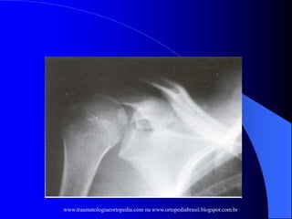 www.traumatologiaeortopedia.com ou www.ortopediabrasil.blogspot.com.br
 