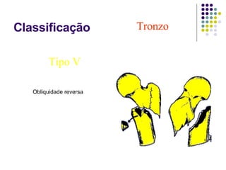 Classificação Tronzo   Tipo V Obliqüidade reversa Obliquidade reversa 