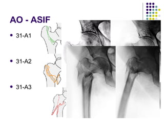 AO - ASIF 31-A1 31-A2 31-A3 