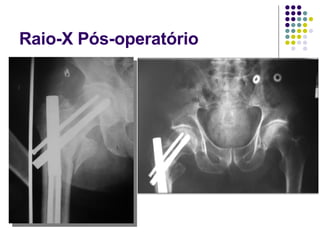 Raio-X Pós-operatório 