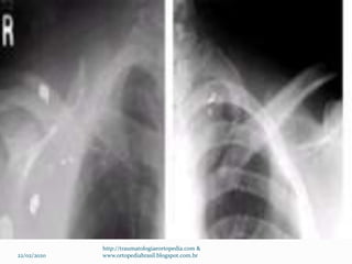 22/02/2020
http://traumatologiaeortopedia.com &
www.ortopediabrasil.blogspot.com.br
 