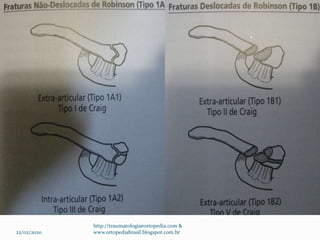 22/02/2020
http://traumatologiaeortopedia.com &
www.ortopediabrasil.blogspot.com.br
 
