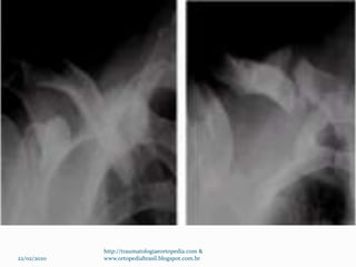 22/02/2020
http://traumatologiaeortopedia.com &
www.ortopediabrasil.blogspot.com.br
 