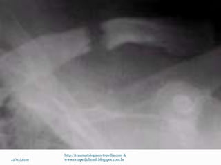 22/02/2020
http://traumatologiaeortopedia.com &
www.ortopediabrasil.blogspot.com.br
 