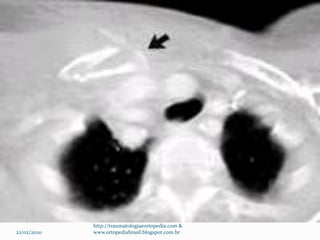 22/02/2020
http://traumatologiaeortopedia.com &
www.ortopediabrasil.blogspot.com.br
 