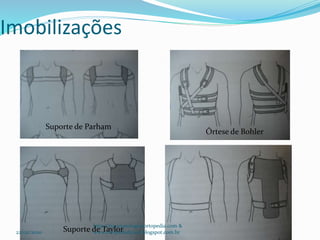 Imobilizações
Suporte de Parham
Órtese de Bohler
Suporte de Taylor22/02/2020
http://traumatologiaeortopedia.com &
www.ortopediabrasil.blogspot.com.br
 