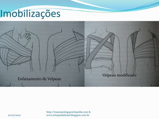 Imobilizações
Velpeau modificado
Enfaixamento de Velpeau
22/02/2020
http://traumatologiaeortopedia.com &
www.ortopediabrasil.blogspot.com.br
 