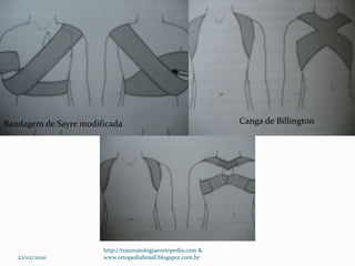Canga de BillingtonBandagem de Sayre modificada
22/02/2020
http://traumatologiaeortopedia.com &
www.ortopediabrasil.blogspot.com.br
 