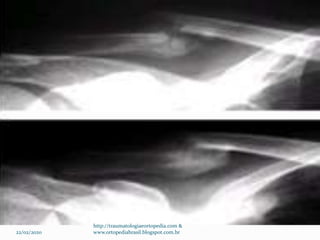 22/02/2020
http://traumatologiaeortopedia.com &
www.ortopediabrasil.blogspot.com.br
 