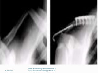 22/02/2020
http://traumatologiaeortopedia.com &
www.ortopediabrasil.blogspot.com.br
 