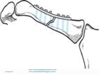 22/02/2020
http://traumatologiaeortopedia.com &
www.ortopediabrasil.blogspot.com.br
 