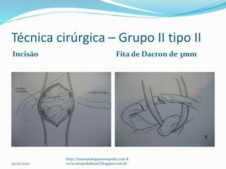 Técnica cirúrgica – Grupo II tipo II
Incisão Fita de Dacron de 3mm
22/02/2020
http://traumatologiaeortopedia.com &
www.ortopediabrasil.blogspot.com.br
 