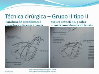 Técnica cirúrgica – Grupo II tipo II
Parafuso de estabilização
coroclavicular com arruela
Sutura Tevdek no. 5 sob a
arruela como banda de tensão
22/02/2020
http://traumatologiaeortopedia.com &
www.ortopediabrasil.blogspot.com.br
 